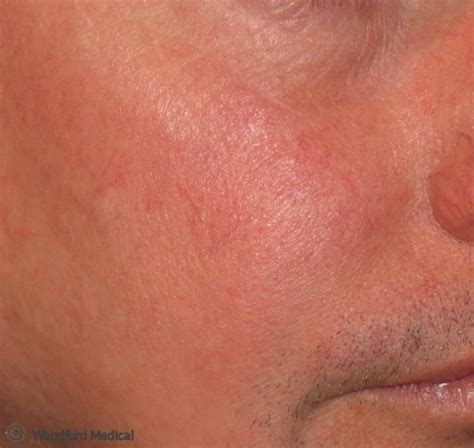 Facial Redness Rosacea And Blushing Woodford Medical