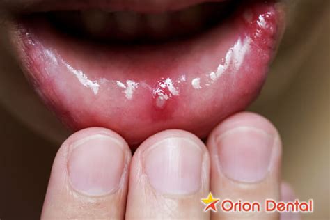Canker Sores Treatments Causes And Prevention Orion Dental
