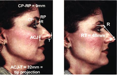 Anatomic Localization Of The Radix H Steve Byrd James D Buri