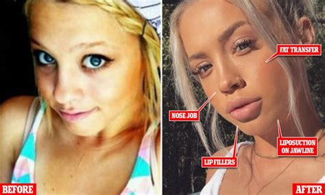 Surgeon Claims Tammy Hembrow May Have Had Fillers And A Nose Job Nose Job Tammy Hembrow