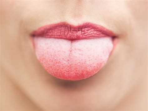quelles sont les raisons pour lesquelles la langue se fissure au centre traitement des fissures