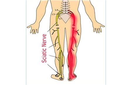 How does acupuncture work for sciatic nerve pain? Acupuncture And Sciatica Pain Relief - Acupuncture Acupressure Points