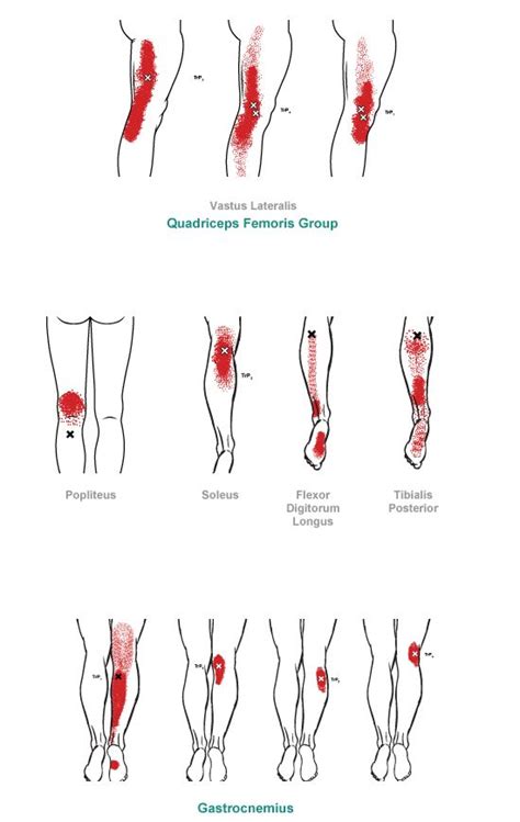 Trigger Point Referral Pain Pattern For The Knee And Lower Leg Tooth