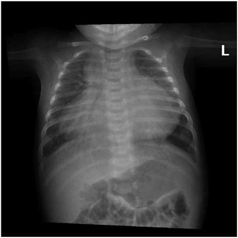 Chest X Ray Anteroposterior Projection Showing Cardiomegaly With