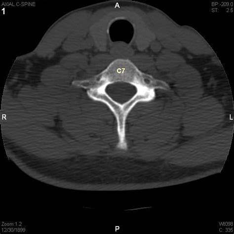 Index Of Radiologyselftestaxialctcervicalspine