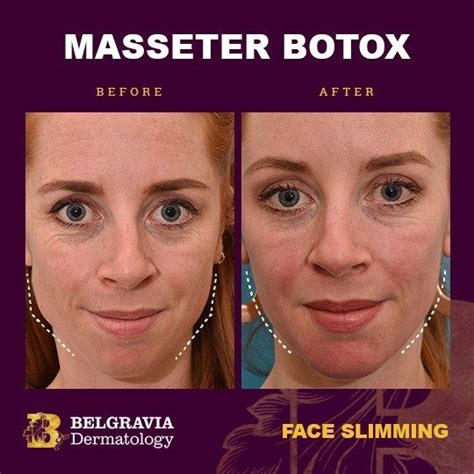 How Long Does Masseter Botox Take To Work The Beautious