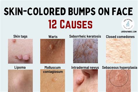 Skin Colored Bumps On Face Causes Pictures Treatment
