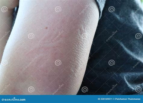 Close Up Shot Of Scars Red Itchy Rashes On Arms Of Asian Women Skin