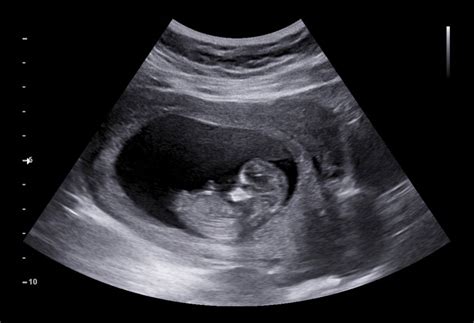 fetal head anatomy ultrasound