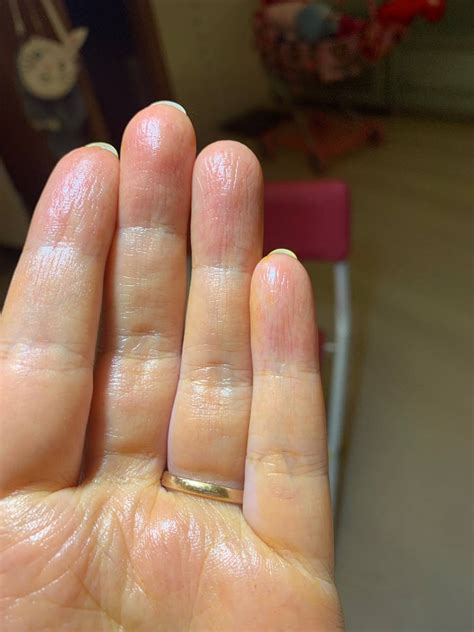 Почему облазит кожа на пальцах рук причины методы лечения