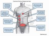 Excessive Gas Pain And Bloating Pictures