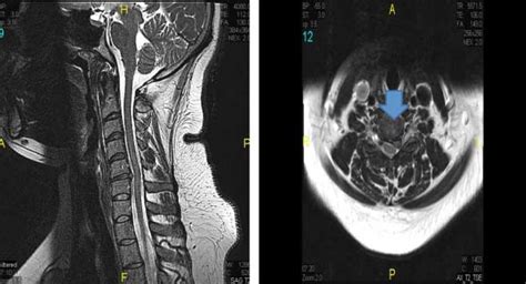 MRI Herniated Disc In Neck