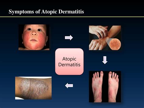 Ppt Causes And Treatment Of Atopic Dermatitis Powerpoint Presentation