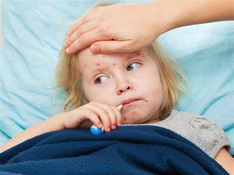 Measles Outbreak In Ohio Infects 82 Kids Most Of Them Unvaccinated