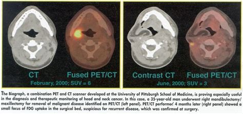 Combined Petct Aids In Head And Neck Cancer Management