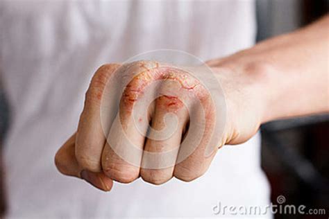 One Caucasian Man Hand With Psoriasis On A White Background