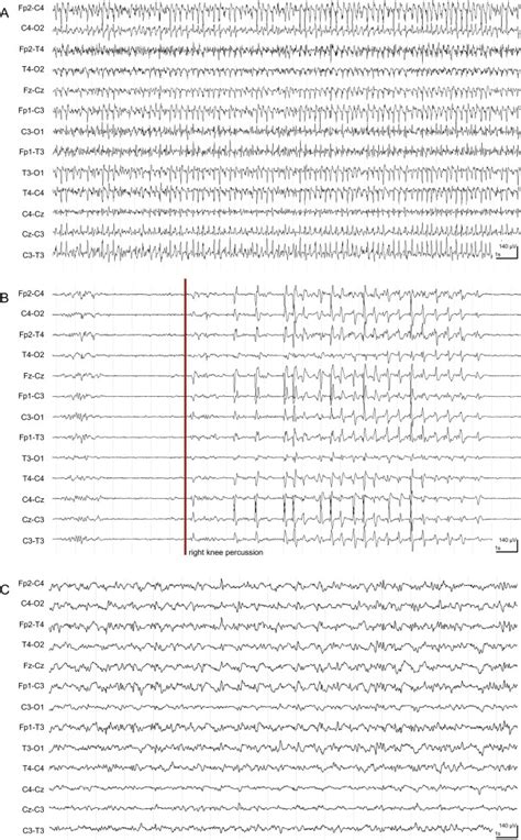 Myoclonic Super Refractory Status Epilepticus With Favourable Evolution