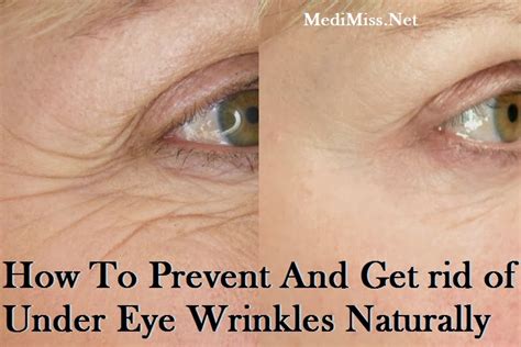 How To Prevent And Get Rid Of Under Eye Wrinkles Naturally Skinnyzine