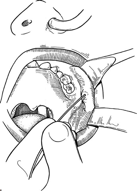 Salivary Duct Surgery And Sialorrhea Surgery Ento Key