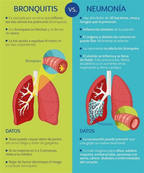 Diferencias Entre Bronquitis y Pulmonía Cuadros Comparativos Cuadro Comparativo