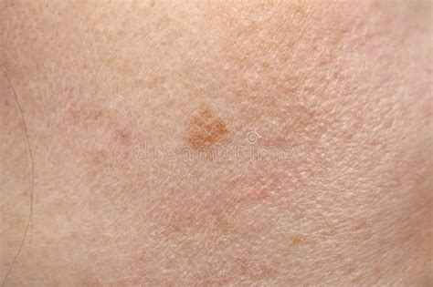 Pigmentation On The Skin Stock Photo Image Of Background 113369052
