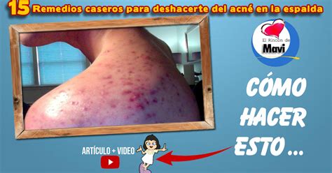 Remedios Caseros Y Naturales Para La Salud Y Belleza Acne En La