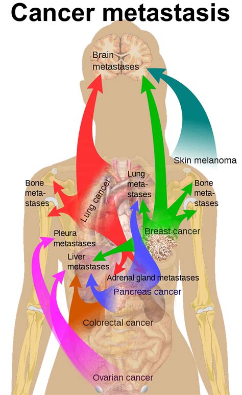 Check spelling or type a new query. Cancer metastasis causes, symptoms and metastasis survival ...