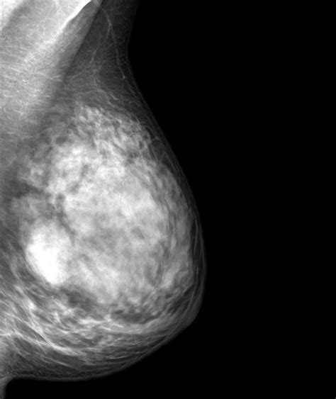 What Is A Breast Xray Two Views