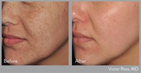 Lumecca Before And After Skin Institute By Marina K Skin