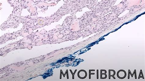 Myofibroma Under The Microscope Pathology Dermpath Dermatology
