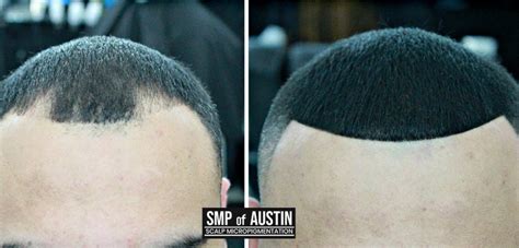 Bald Spot Coverage For Women With Scalp Micropigmentation Smp Of Austin