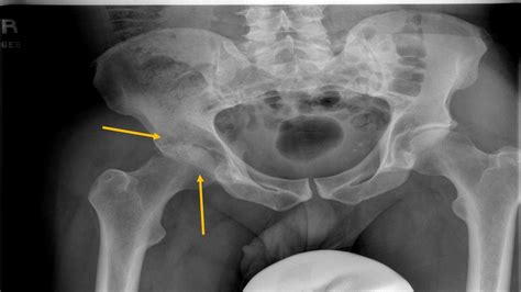 X Ray Pictures Of Hip Arthritis
