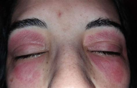 Eyelid Dermatitis Causes Symptoms Diagnosis And Treatment