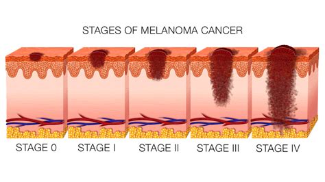 Spread Of Malignant Melanoma Metastatic Melanoma Dermnet