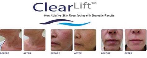 Skin Rejuvenation Clearlift Laser Ovela Clinic
