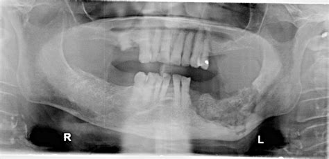 Drug Induced Osteonecrosis Of The Jaws Bauer Smiles Dionj