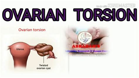 Ovarian Torsion Youtube