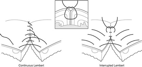 Fundamentals Of Sutures Needles Knot Tying And Suturing Technique