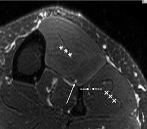 Peroneal Nerve Mri