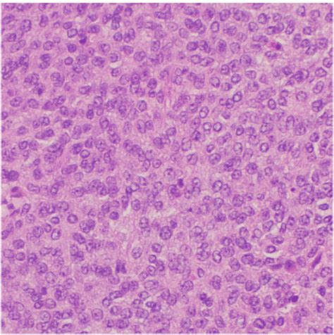 Adult Granulosa Cell Tumor With Solid Growth Pattern Consisting Of Download Scientific Diagram