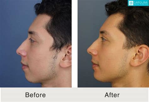 Chin Implant To Augment The Jawline Carolina Facial Plastics