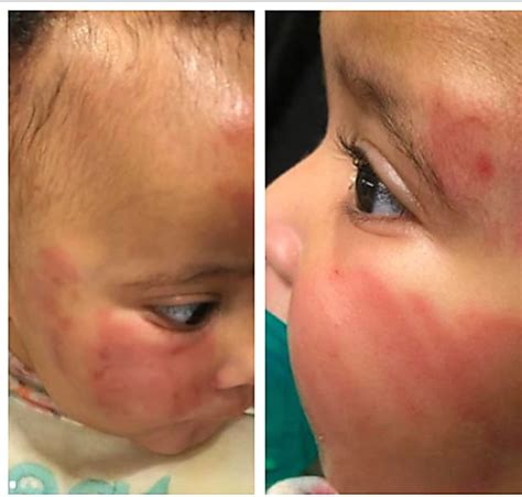 Baby Badly Bruised At Unlicensed Newark Daycare Mom Says Essex Daily