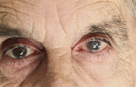 Cataracts Knowing The Symptoms Wellish Vision Institute