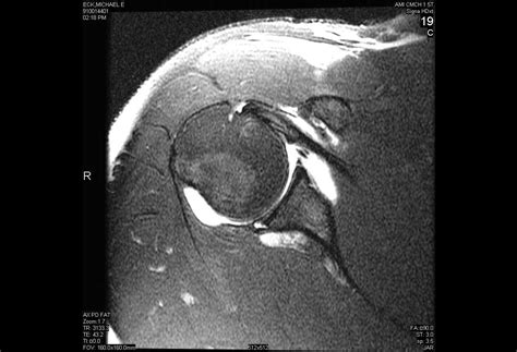 Arthroscopic Repair Of Posterior Labral Tear With Paralabral Cyst My Xxx Hot Girl