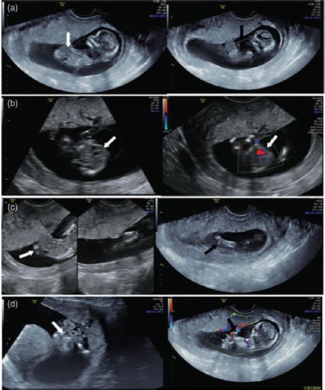 Figure 1 From First Trimester Diagnosis Of Body Stalk Anomaly