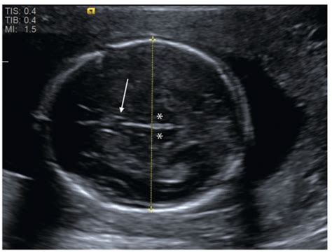 Fetal Imaging Ultrasound And Magnetic Resonance Imaging Obgyn Key