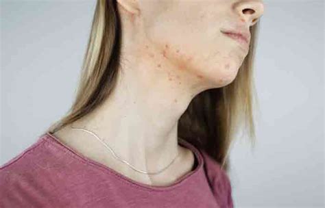 7 Ways To Get Rid Of Pitted Acne Scars Causes And Types