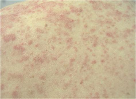 Drug Induced Subacute Cutaneous Lupus Erythematosus Related To Doxycycline