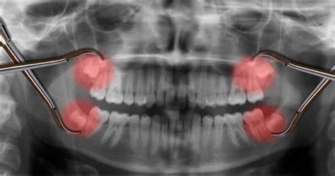 Can Impacted Wisdom Teeth Cause Abscess T Tapp