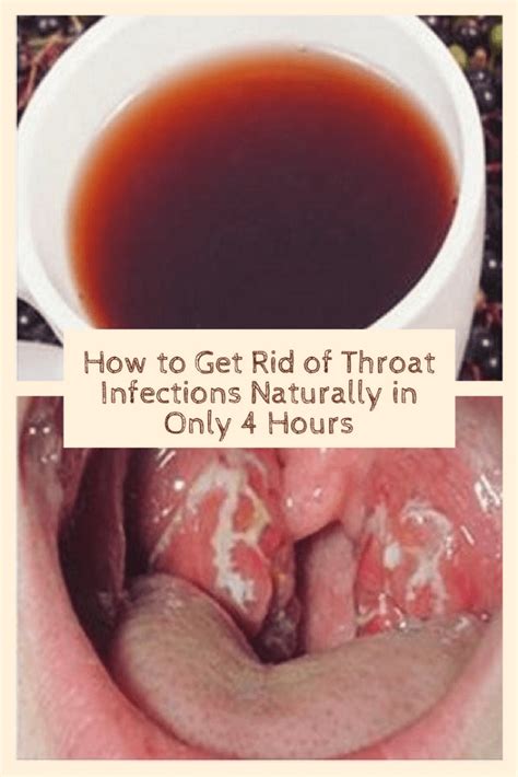 How To Get Rid Of Throat Infections Naturally In Only 4 Hours Throat Infection Sore Throat